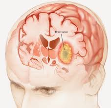 Best Doctor For Skull Base Tumour Treatment in Kharghar – Dr. Rathan Shetty